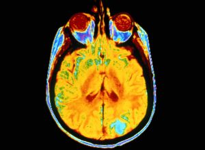 Brain Cancer